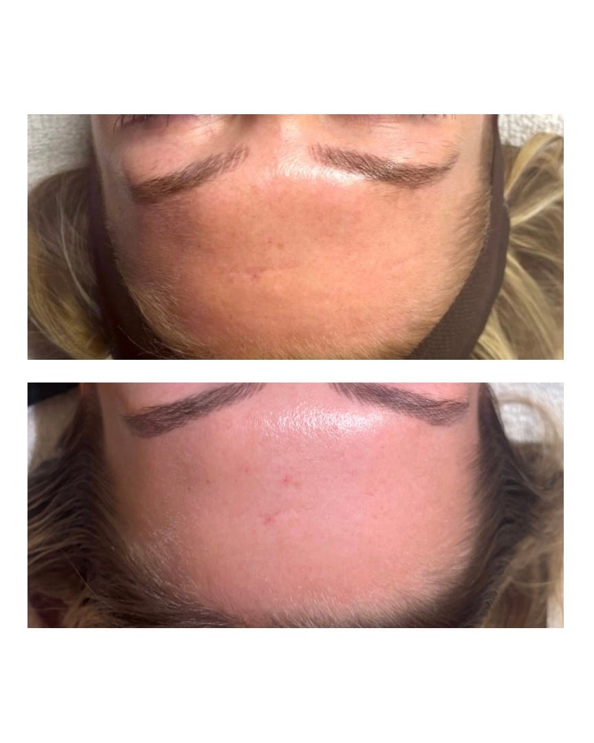 Microneedling procedure